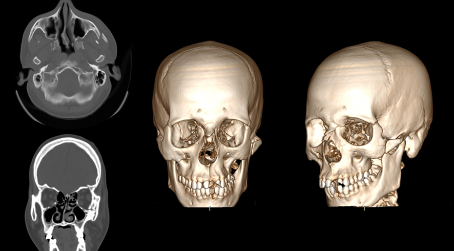 顔面CT画像　3D