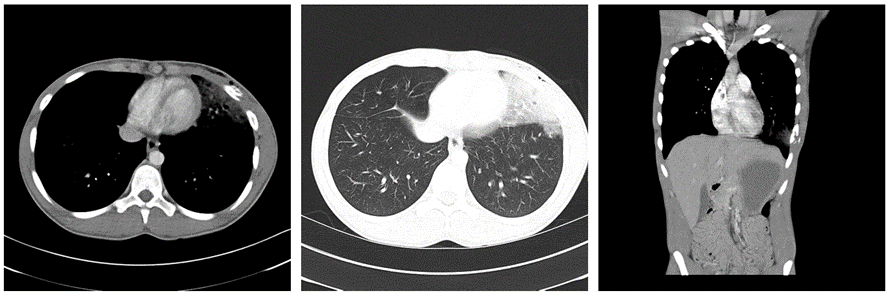 胸部CT画像　肺挫傷