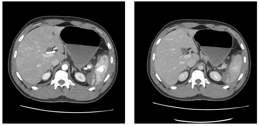 腹部CT画像　膵損傷
