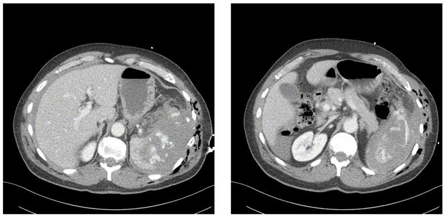 腹部CT画像　脾臓中心
