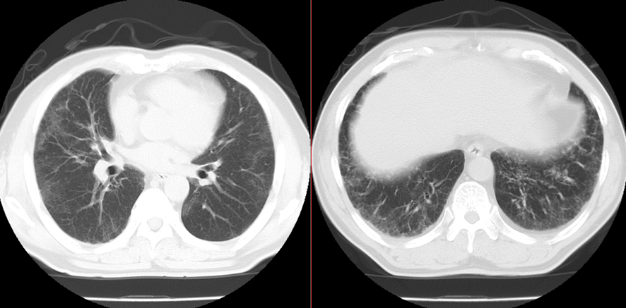 胸部CT-間質性肺炎