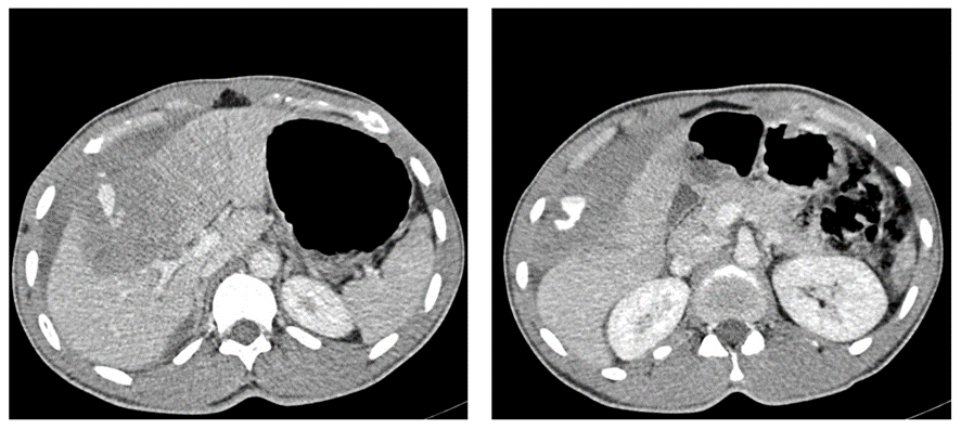 腹部CT画像　肝損傷