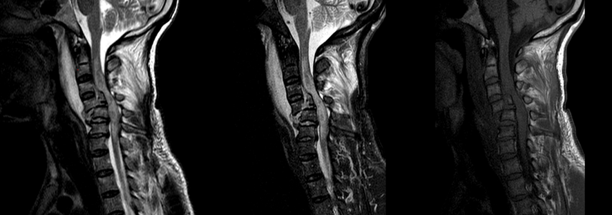 MRI画像　頚椎損傷