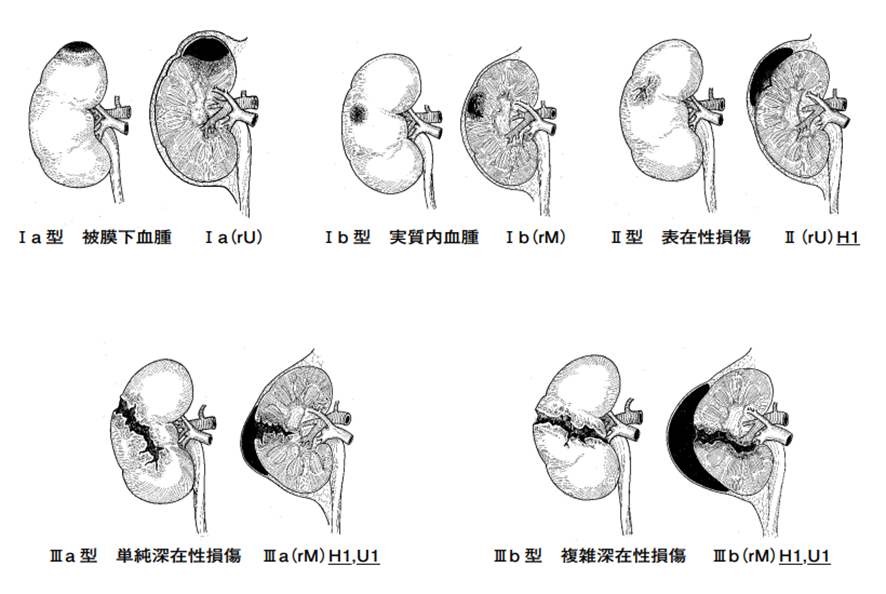 腎損傷の分類