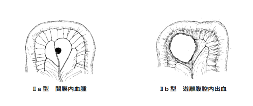腸管損傷イメージ図