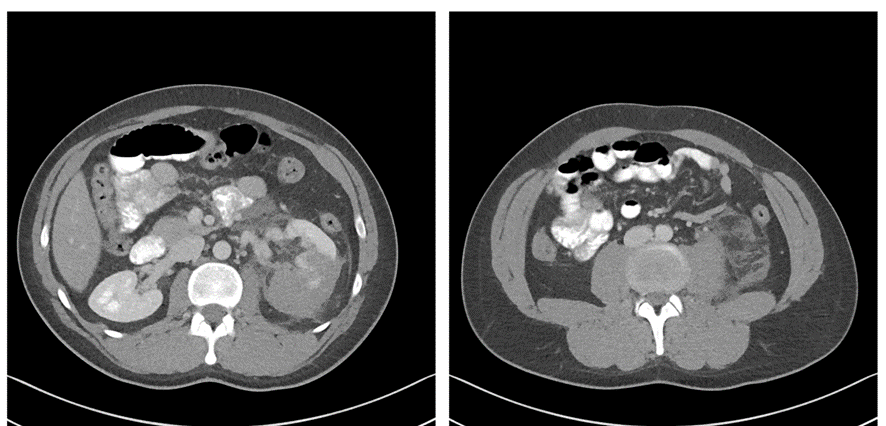 腹部CT画像-腎損傷