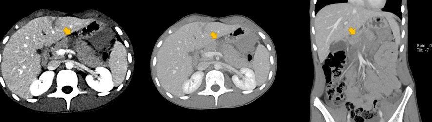 腹部CT画像-膵損傷