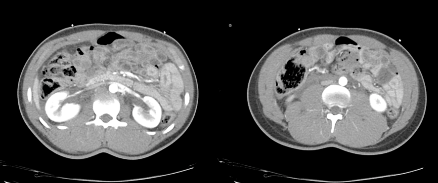 腹部CT画像-腸管損傷
