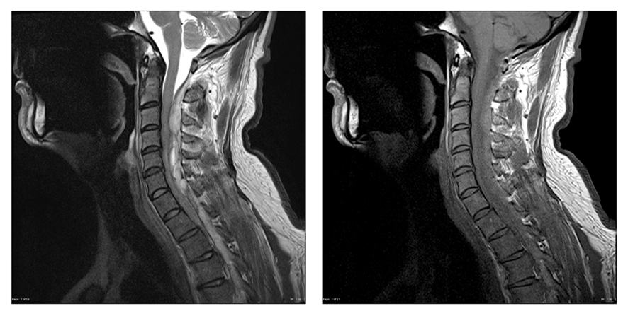 頚椎MRI-硬膜外血腫