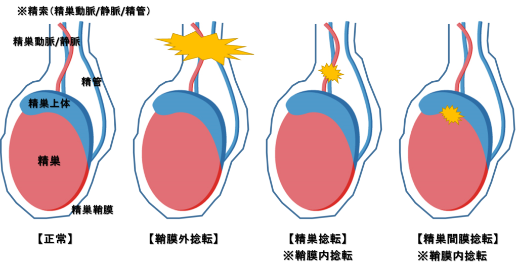 精巣捻転が起きる仕組み