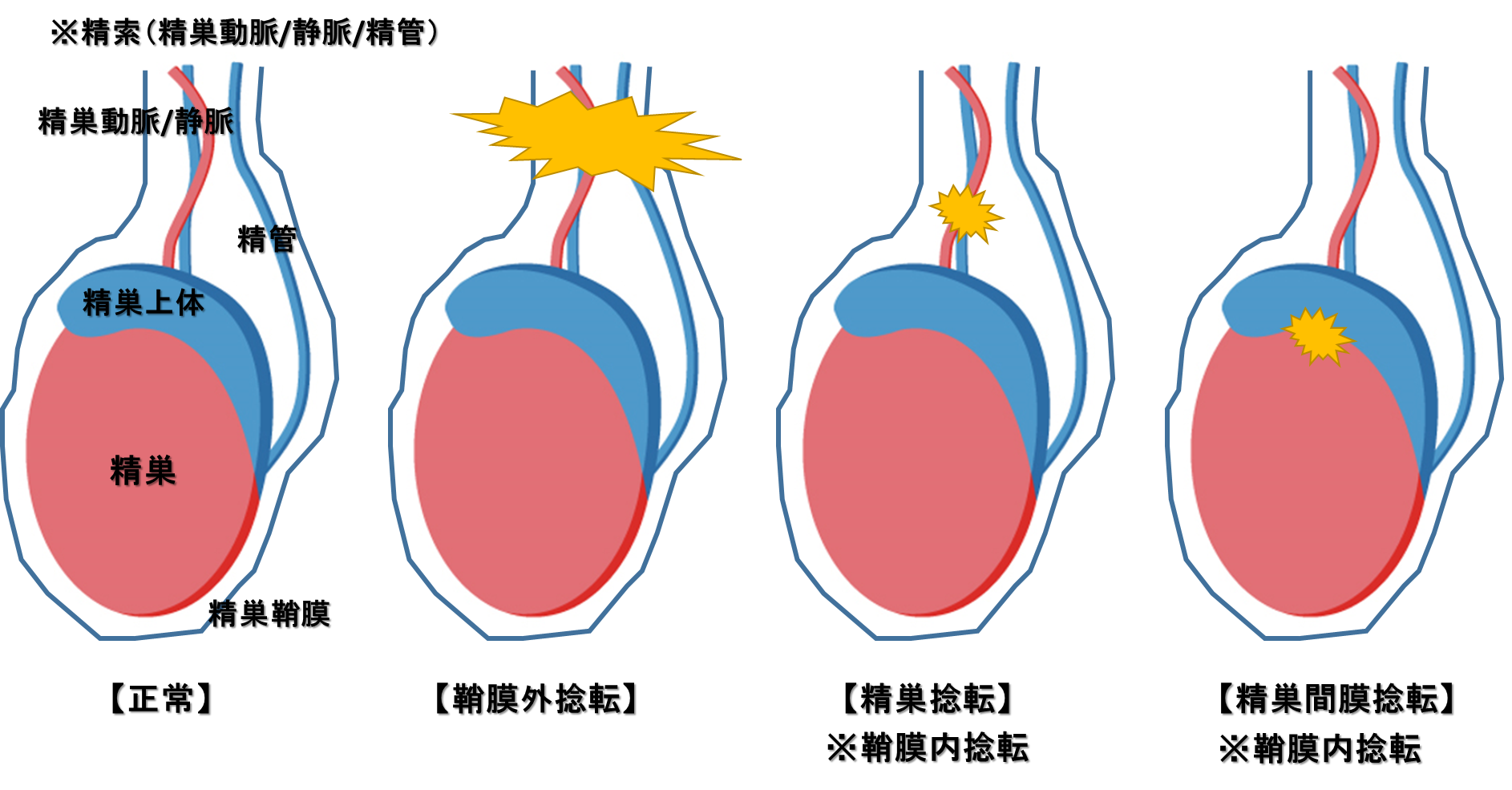 精巣捻転（testicular torsion）