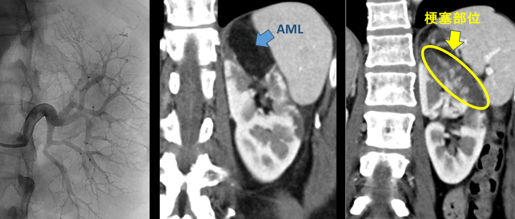 腹部CT　AMLと腎梗塞