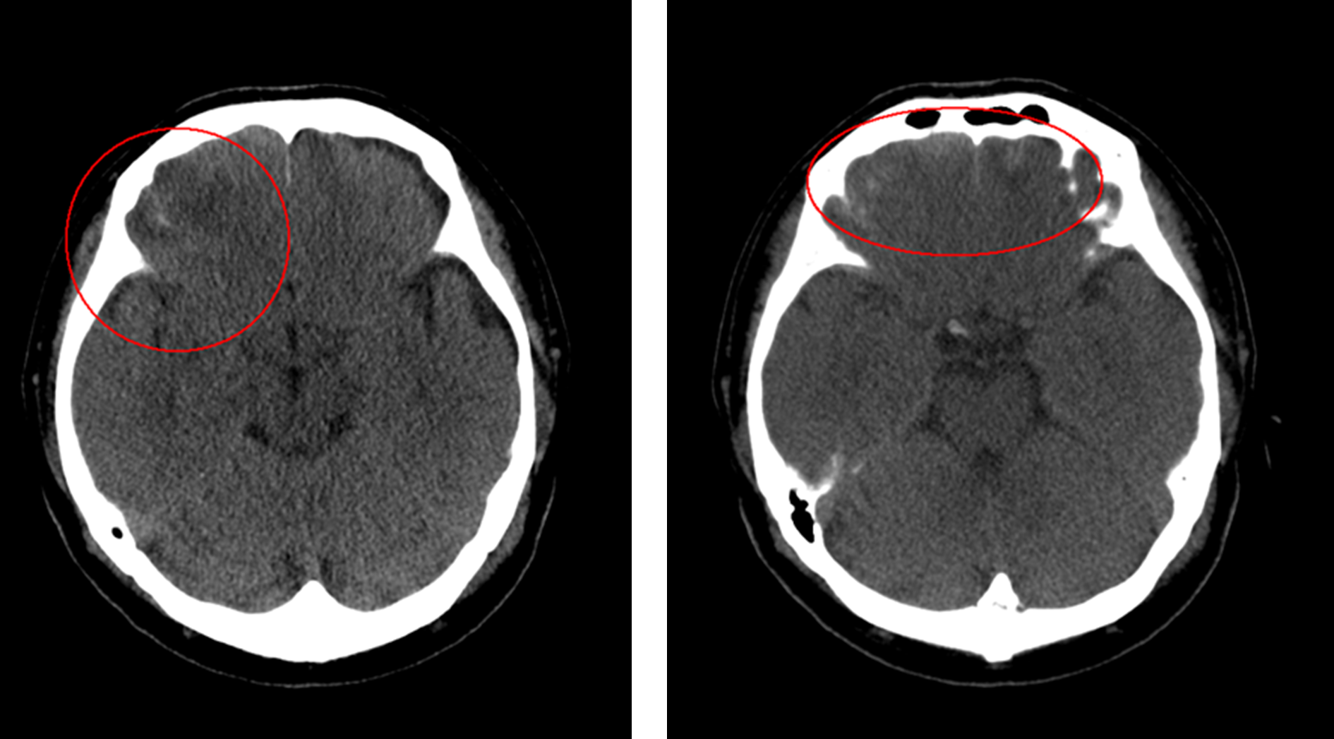 脳挫傷(cerebral contusion)