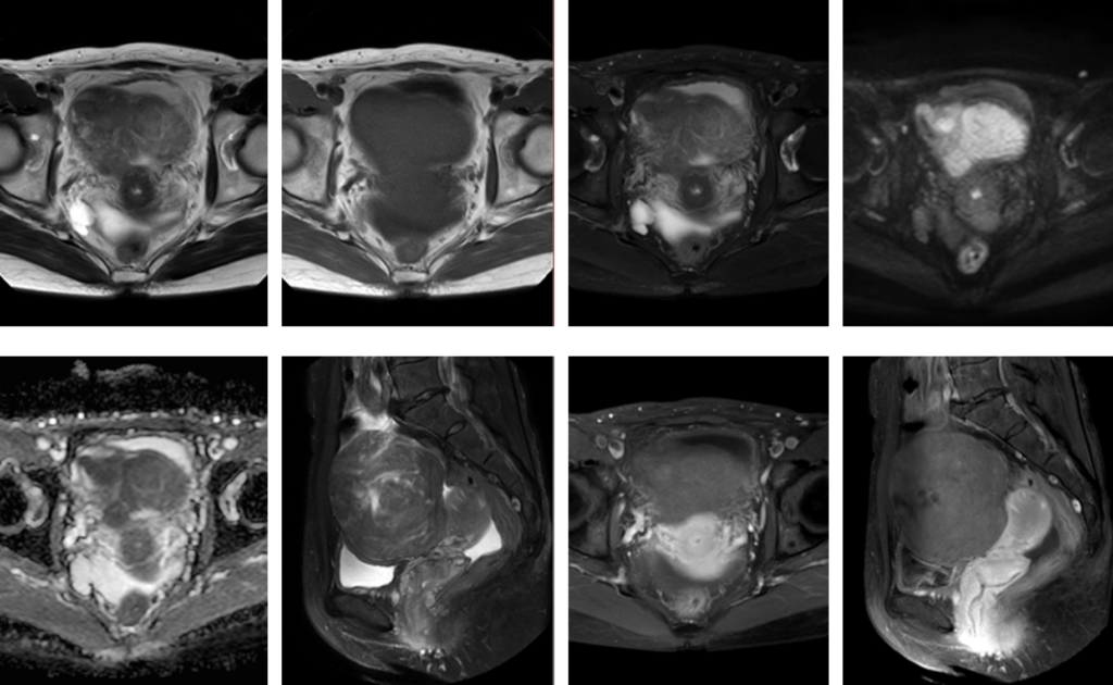 骨盤MRI　子宮筋腫捻転　2方向