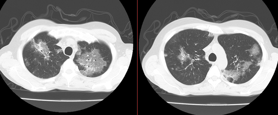胸部CT-ウィルス性肺炎