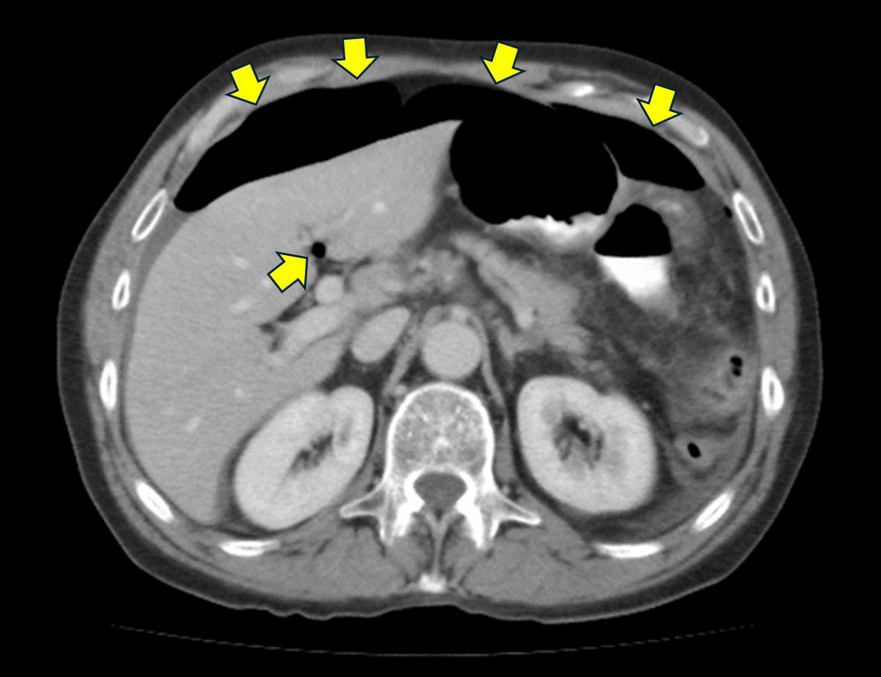 消化管穿孔（gastrointestinal perforation）