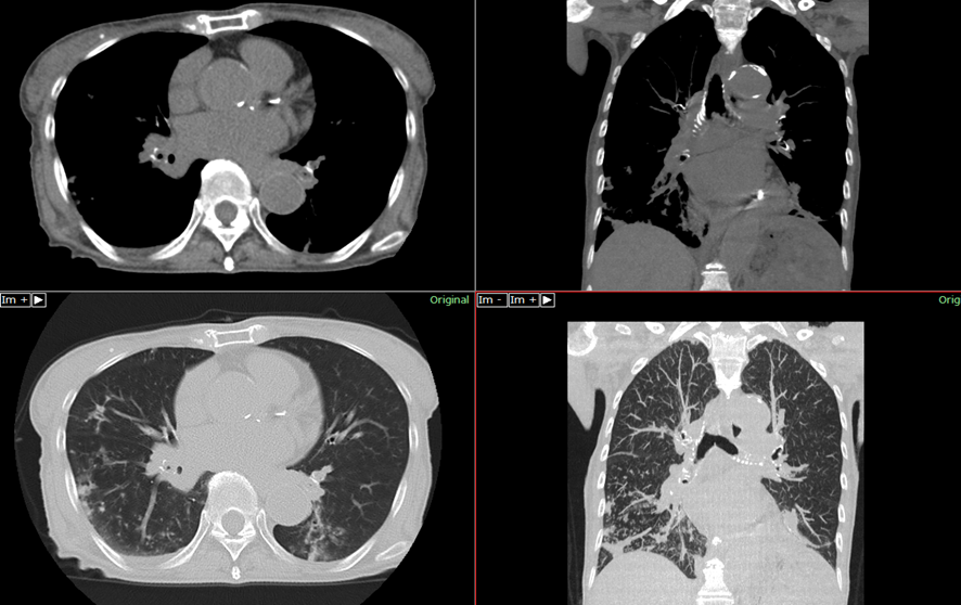 胸部CT-誤嚥席肺炎