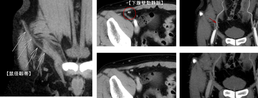鼠径靱帯と下腹壁動静脈