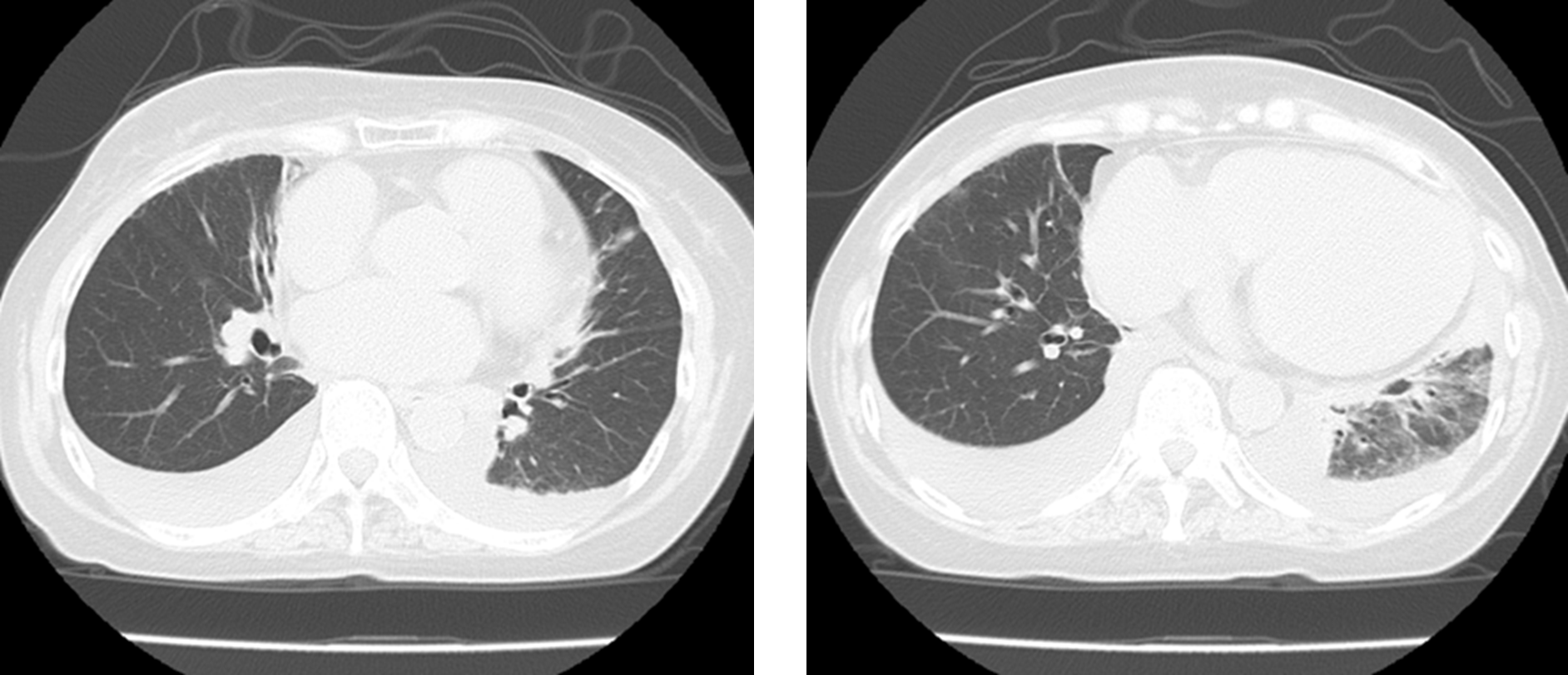 Dash Radiology 陰圧性肺水腫 _ 陰圧性肺水腫 症状 | 陰圧性肺水腫 & Wikimore – XVBI
