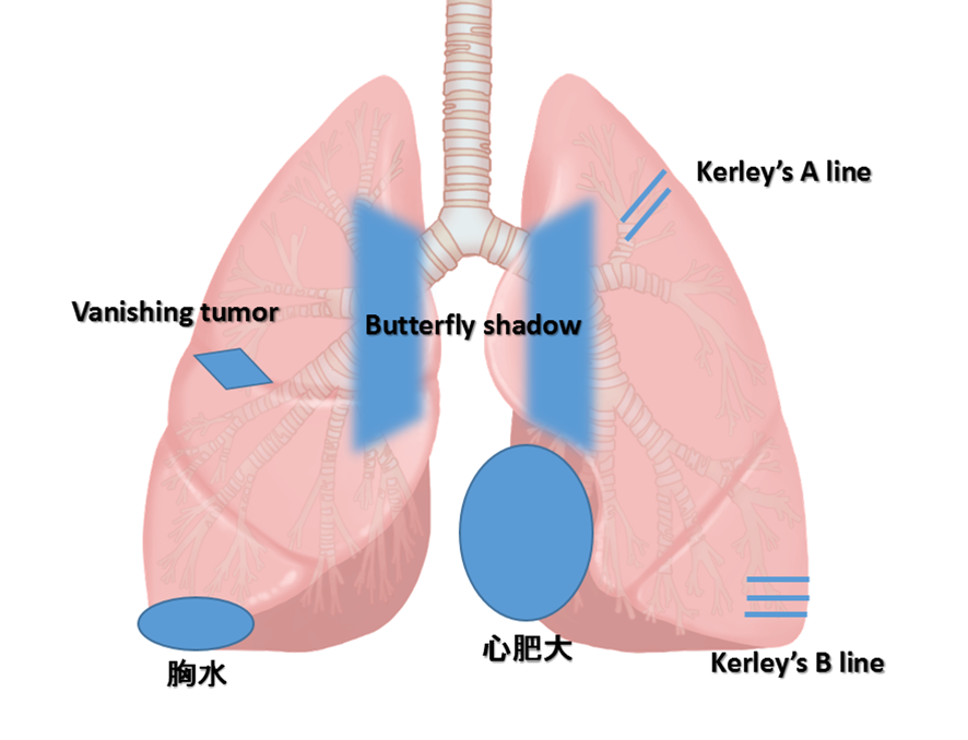 肺水腫の代表的な画像所見