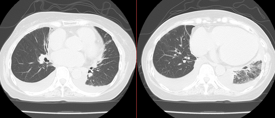 胸部CT-肺水腫