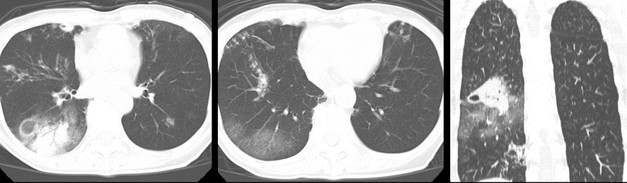 胸部CT-肺結核