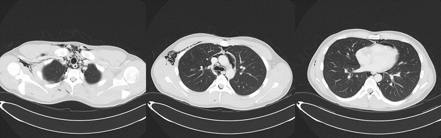 胸部CT-突発性食道破裂