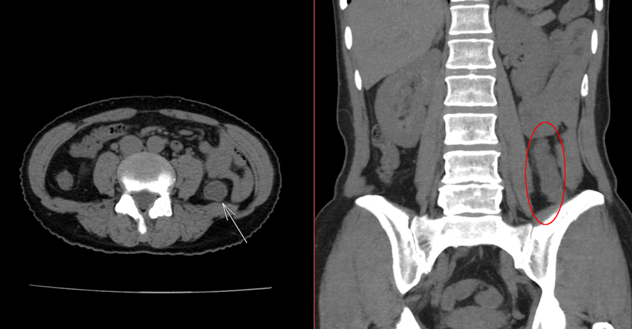 腹部CT-虚血性大腸炎