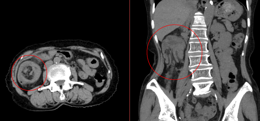 腹部CT-右結腸腸重積