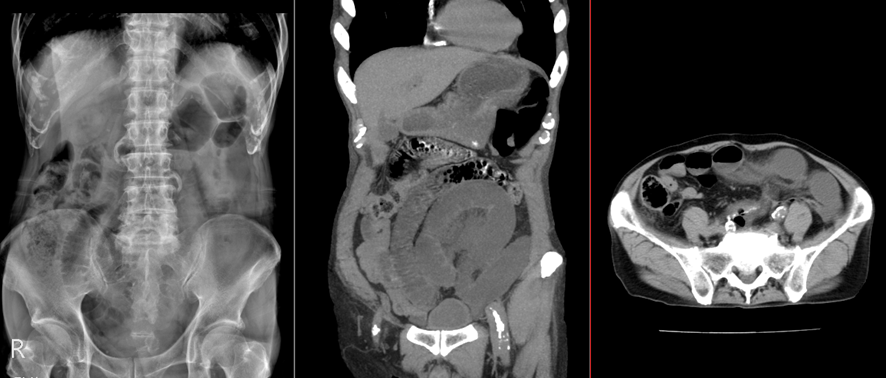 腹部CT-小腸イレウス
