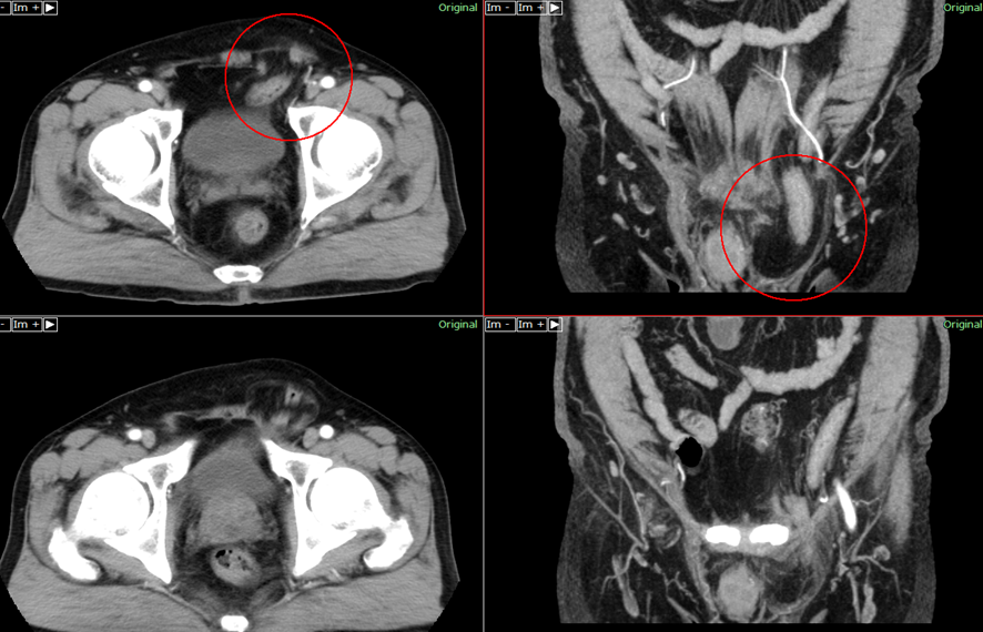 腹部CT-内鼠径ヘルニア