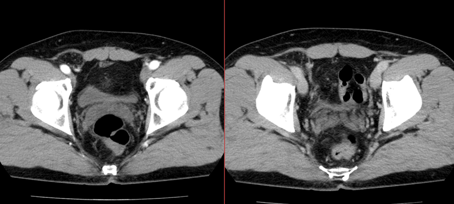 腹部CT-外鼠径ヘルニア