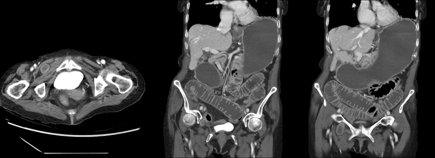 腹部CT-閉鎖孔ヘルニア