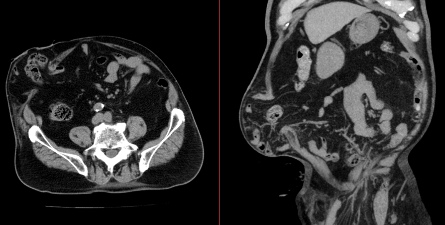 腹部CT-腹壁ヘルニア