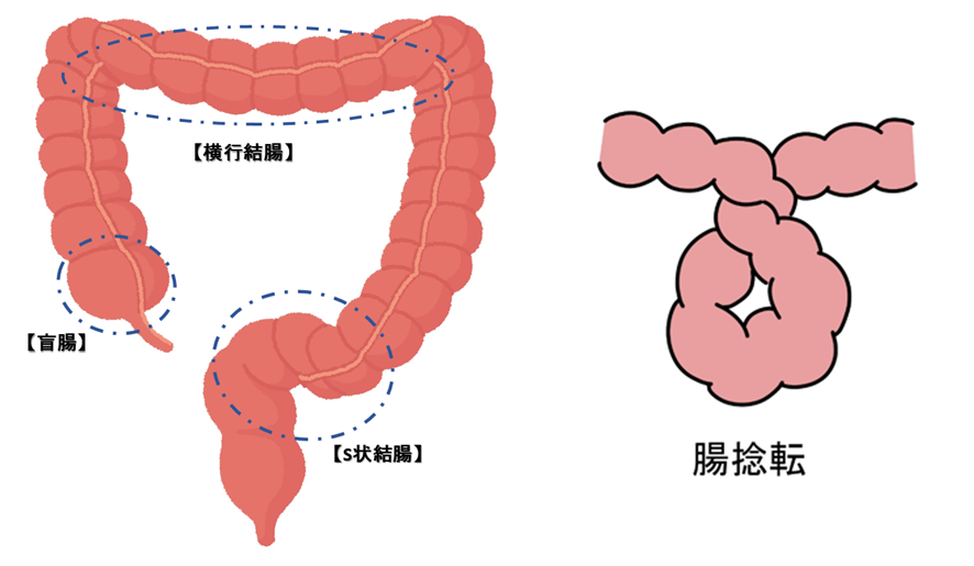 腸捻転　好発部位