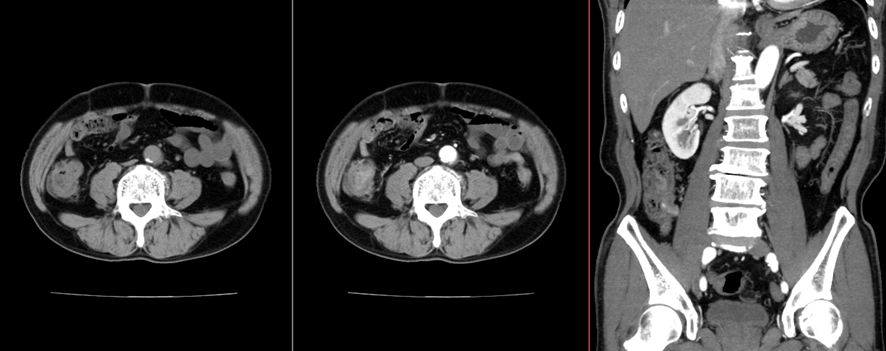 腹部CT　大腸憩室炎