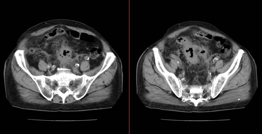 腹部CT　S状結腸穿孔