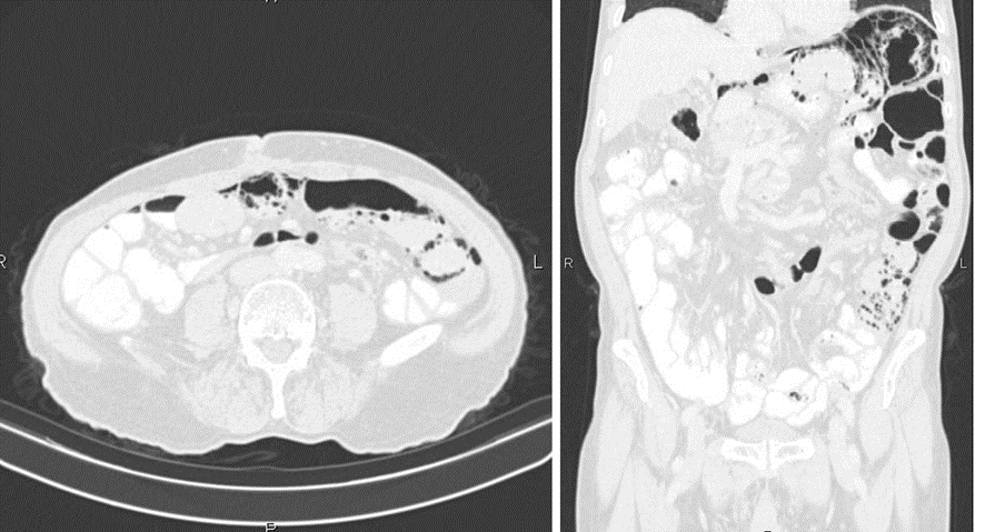 腹部CT　腸管気腫症　air view