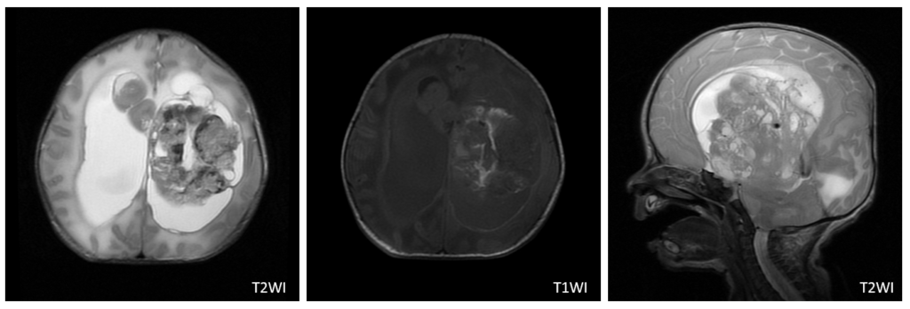 頭部MRI-teratoma-holocranial