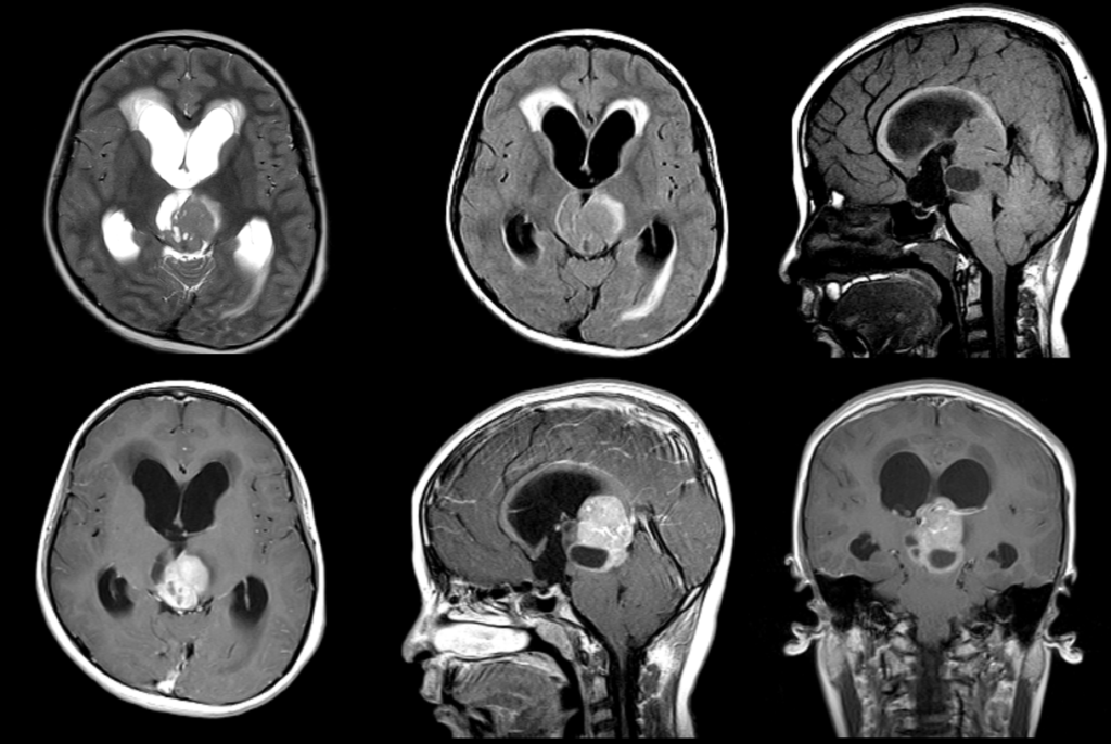 頭部MRI-Germinoma