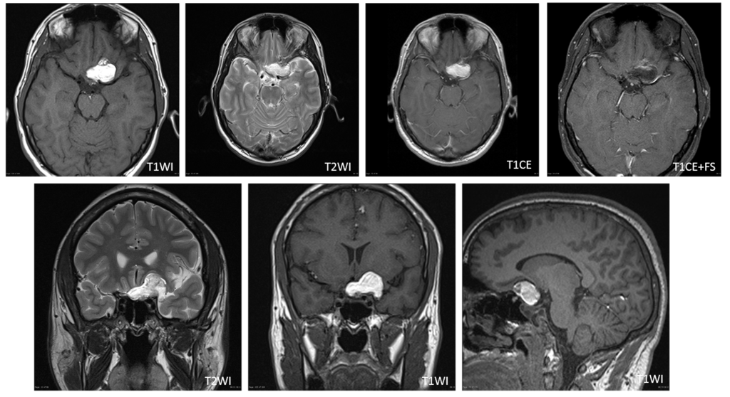 頭部MRI-teratoma