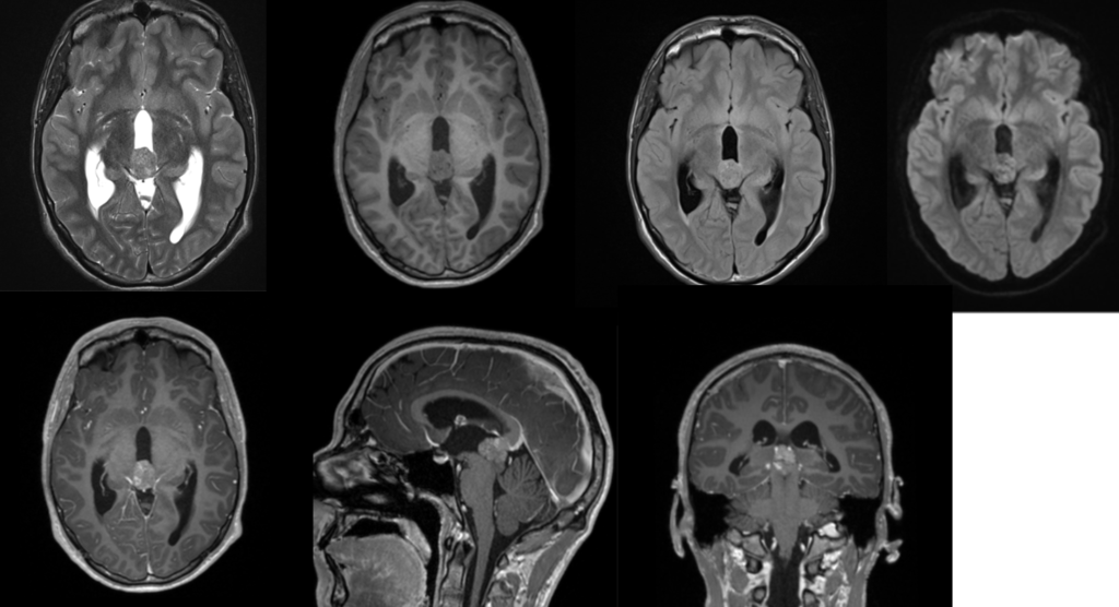 頭部MRI-Germinoma2