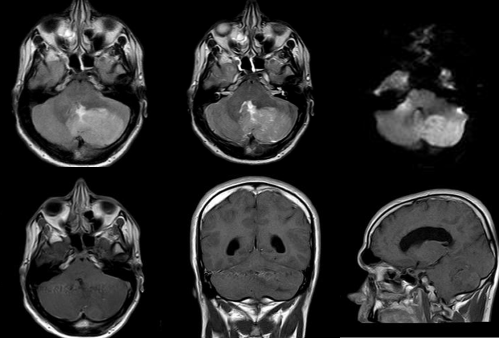 頭部MRI-髄芽腫