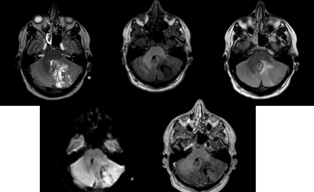 頭部MRI-髄芽腫2