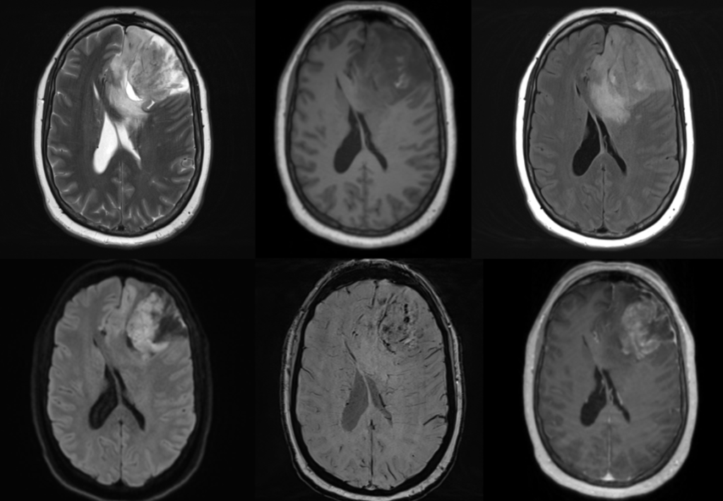 頭部MRI-oligodendroglioma