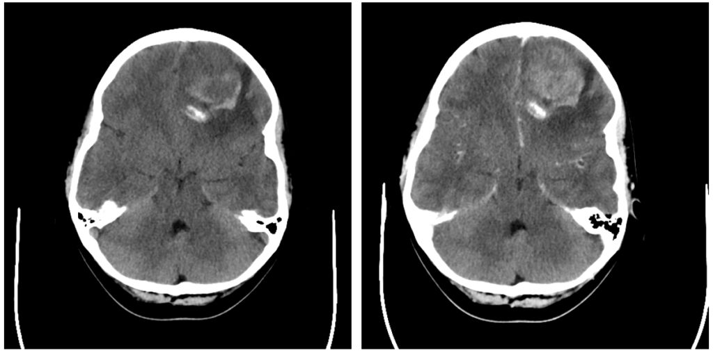 頭部CT-oligodendroglioma