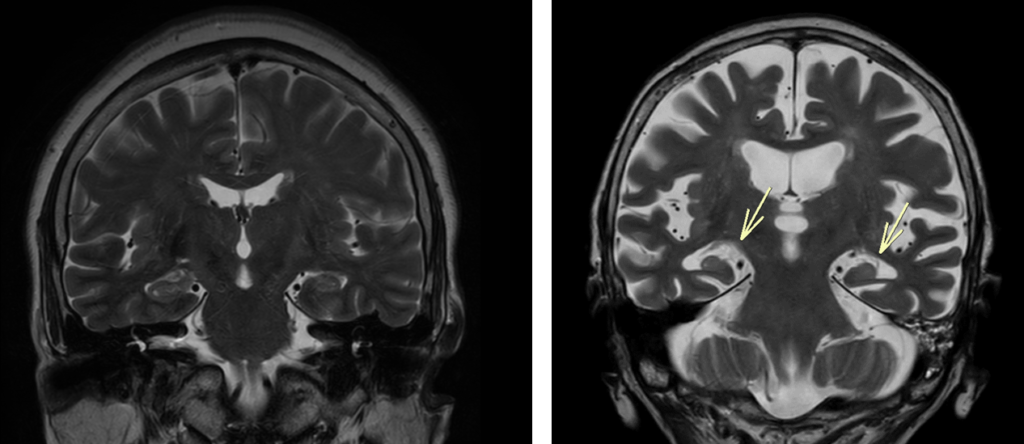 頭部MRI-アルツハイマー病比較