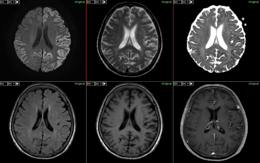 頭部MRI-ヤコブ病