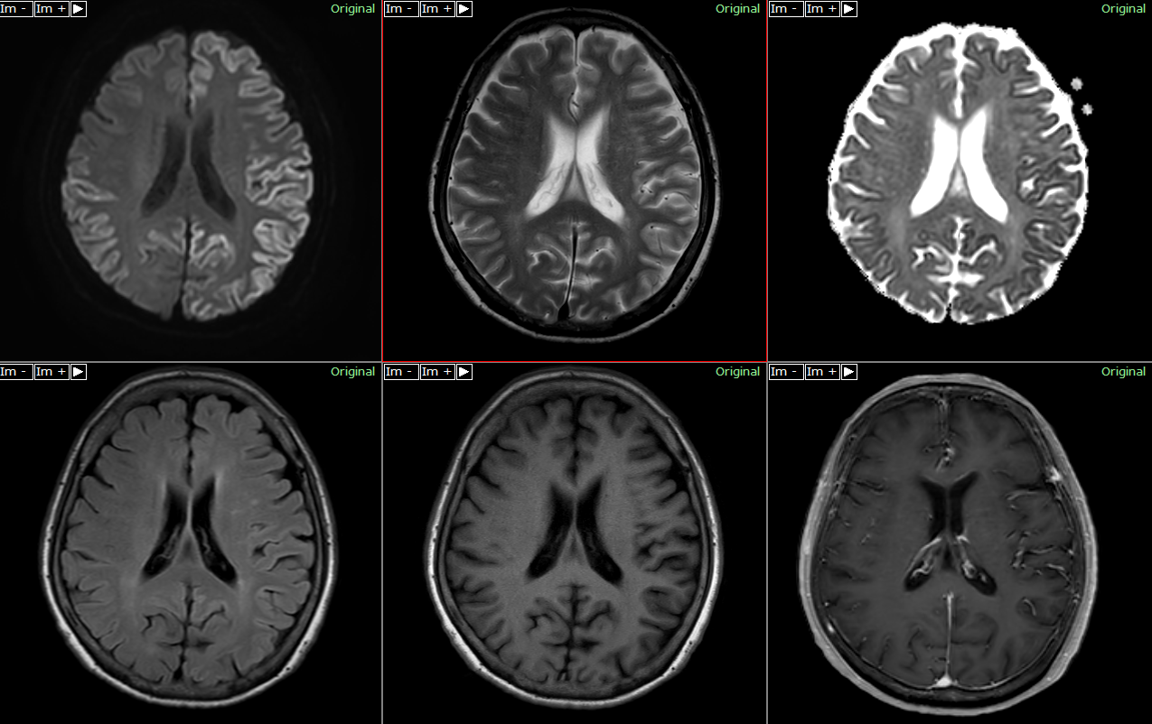 クロイツフェルト・ヤコブ病（CreutzfeldtJakob disease）