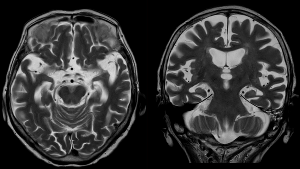 頭部MRI-アルツハイマー病